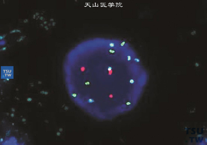 安必平尿路上皮癌FISH探针可见CSP3、CSP7、CSP17染色体数目增多，为非整倍体（红：17号染色体，绿：3号染色体，青：7号染色体）