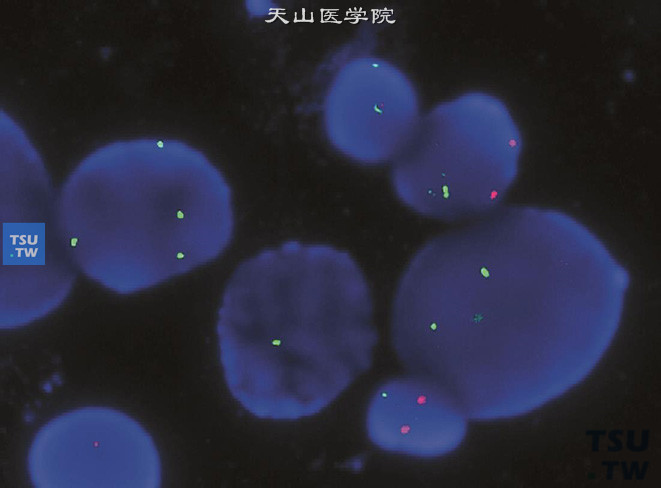 GSP p16纯合性缺失（红：GSP P16 绿：3号染色体），FISH结果阳性