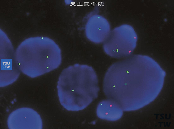 病例二：膀胱癌尿路上皮癌尿细胞学图谱