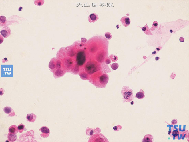 高级别尿路上皮癌：图中央的肿瘤细胞团中细胞异型显著、核染色质较细腻，核仁可见；周围散在单个异型的肿瘤细胞，细胞有退变（核固缩深染、胞质崩解呈颗粒状），左下可见核分裂象