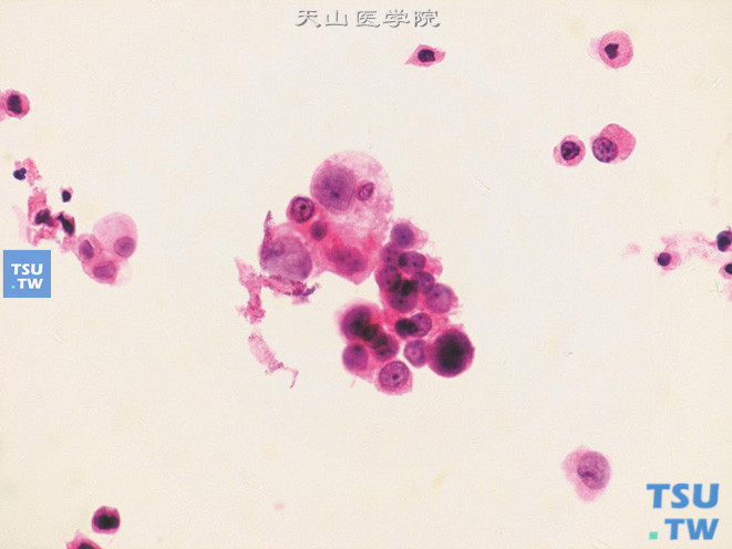 高级别尿路上皮癌：图中央的肿瘤细胞团中细胞异型显著、大小差别明显，但核染色质较细腻，核仁可见；周围散在单个异型的肿瘤细胞，细胞有退变（核固缩深染、胞质崩解呈颗粒状）