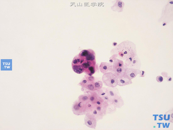 高级别尿路上皮癌：图中央的肿瘤细胞团与周围正常的尿路上皮细胞相比，细胞异型显著、核染色质增粗，核膜明显不规则，有“细胞吞噬现象”；其上方及右侧可见单个异型的肿瘤细胞