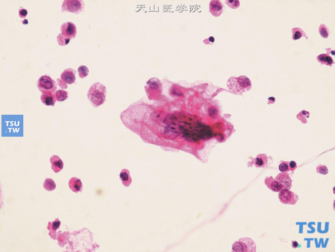 高级别尿路上皮癌：图中央可见异型显著的多核瘤巨细胞、核染色质较细腻，核仁可见；周围散在单个异型的肿瘤细胞，细胞有退变（核固缩深染、胞质崩解呈颗粒状）