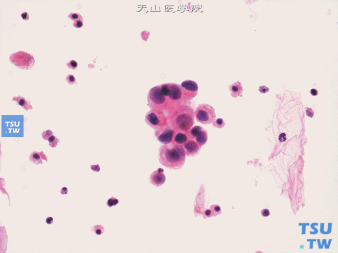 高级别尿路上皮癌：图中央的肿瘤细胞团中细胞异型显著、核染色质较细腻，核仁可见；周围散在单个退变的肿瘤细胞（核固缩深染、胞质崩解呈颗粒状），背景中可见红细胞