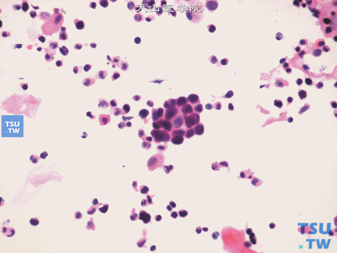 高级别尿路上皮癌：肿瘤细胞成团或单个散在排列，细胞异型显著、核染色质明显增粗、深染，细胞有退变