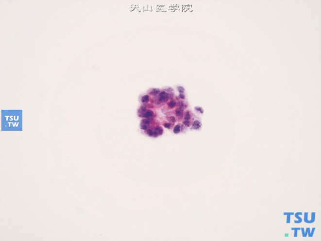 肿瘤细胞呈片排列，似有极向；细胞轻度异型，核染色质增粗、深染，部分可见小核仁。组织学证实：宫颈鳞癌侵及膀胱