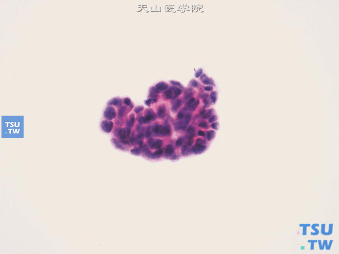 肿瘤细胞呈重叠片状排列，细胞团边缘较光滑，似有极向；细胞轻度异型，核染色质增粗、深染。组织学证实：宫颈鳞癌侵及膀胱