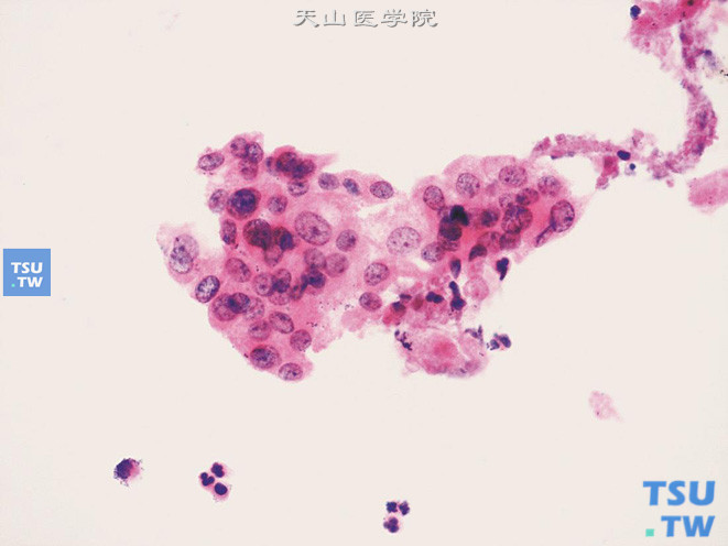 前列腺癌侵及膀胱：片状肿瘤细胞团，胞质颗粒状；胞核大小不一，核染色质颗粒状，可见清晰的核仁
