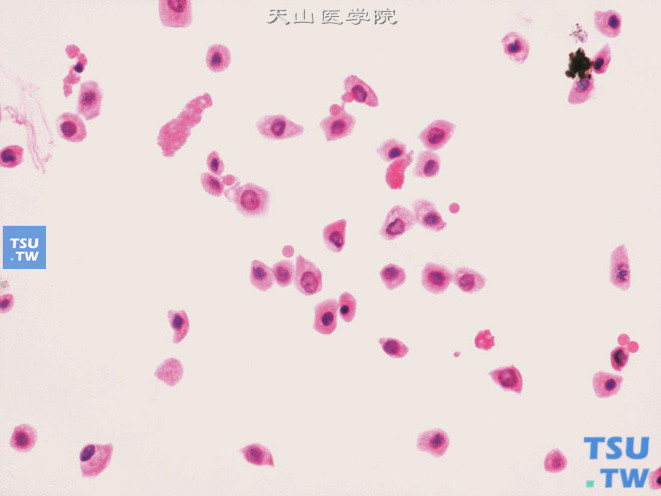 膀胱嗜铬细胞瘤：肿瘤细胞单个散在不成团，细胞异型不明显，核染色细腻，可见小核仁