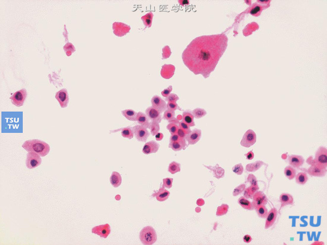 膀胱嗜铬细胞瘤：肿瘤细胞单个散在不成团，细胞异型不明显，核染色细腻，可见小核仁。右下角显示退变的肿瘤细胞