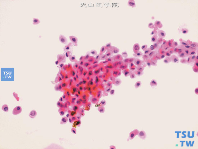 膀胱嗜铬细胞瘤：成片的不同程度退变的肿瘤细胞，异型不明显，核染色细腻，胞质红染颗粒状