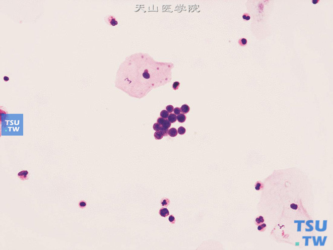 膀胱小细胞癌：肿瘤细胞小而一致，体积略大于成熟淋巴细胞，相互黏附呈簇，胞质稀少，核染色质细颗粒，呈“胡椒盐样”