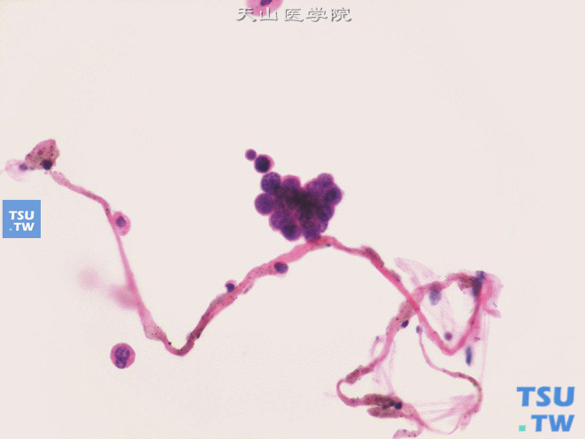 膀胱小细胞癌：肿瘤细胞小而一致，体积略大于成熟淋巴细胞，相互紧密黏附成团，胞质稀少，可见典型的“胡椒盐样”核