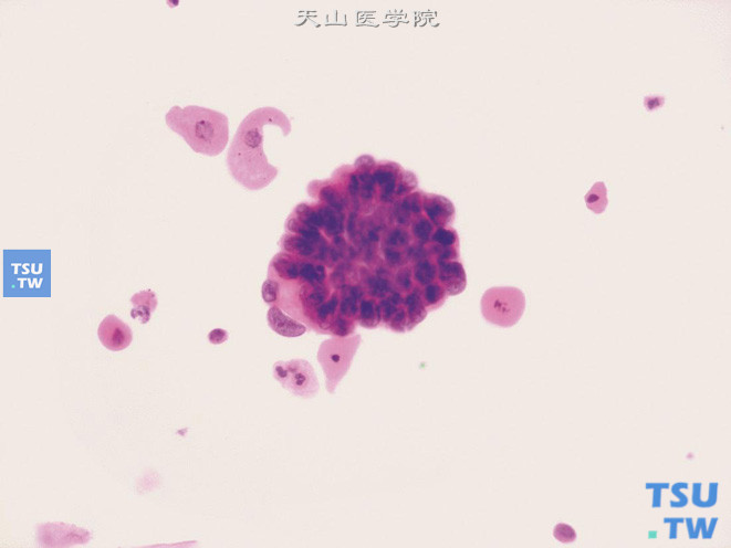 子宫内膜样腺癌转移：可见重叠排列的肿瘤细胞团，核偏位分布，细胞有异型，核膜不规则，可见核仁