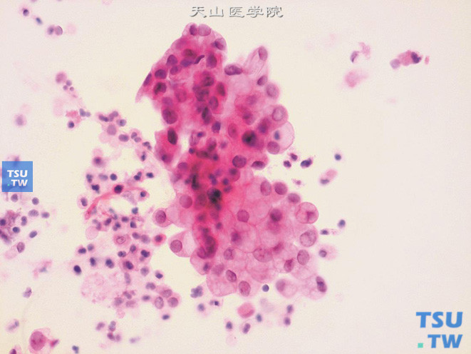留置导尿管的尿液标本：可见大团脱落的尿路上皮细胞，胞质呈空泡状，细胞核增大，核膜规整，核染色质细腻，可见小核仁。背景中可见散在退变、核固缩的上皮细胞