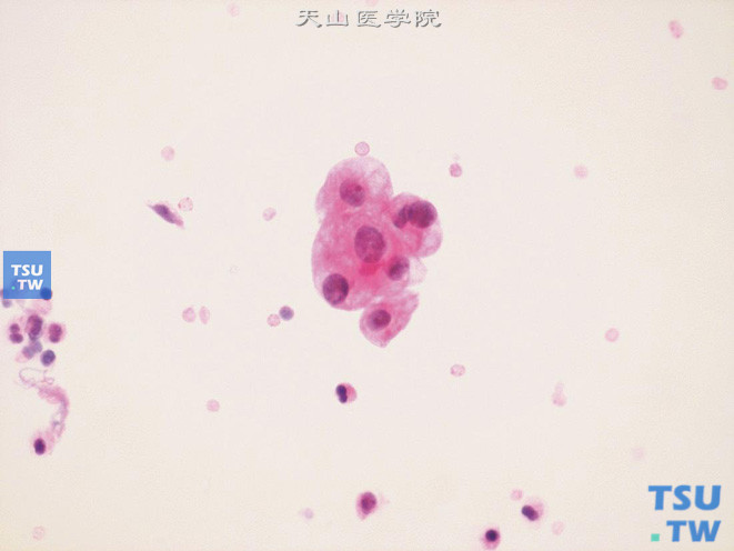 留置导尿管的尿液标本：红细胞的背景中可见小团增生的尿路上皮细胞，胞质呈空泡状，细胞核增大，核膜规整，核染色质细腻，可见小核仁