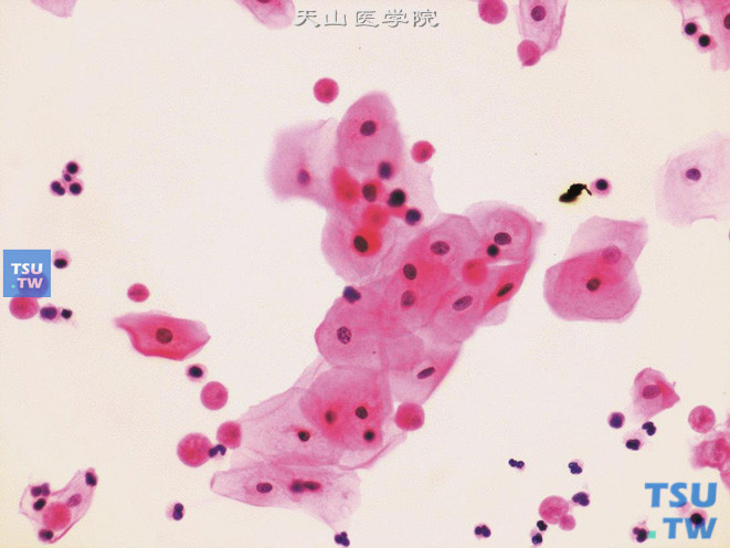 成片的尿路上皮细胞和少量炎症细胞之间，散在多量粉染的滴虫，个别滴虫覆盖在上皮细胞表面