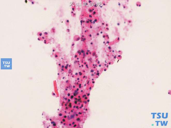 退变的上皮细胞、胞质碎屑及少量炎症细胞混合成片（膀胱尿路上皮癌患者，回肠代膀胱术后）