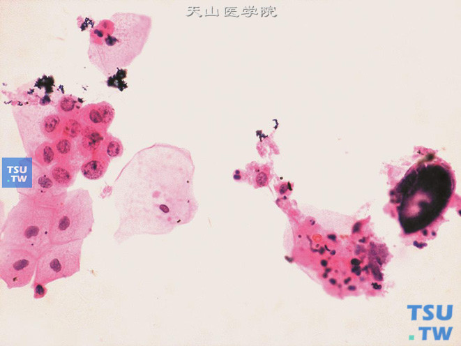 小片状排列的尿路上皮细胞，左侧中心细胞团的细胞核增大，核染色质呈粗颗粒状，胞质红染；右侧可见结石碎屑（肾结石）