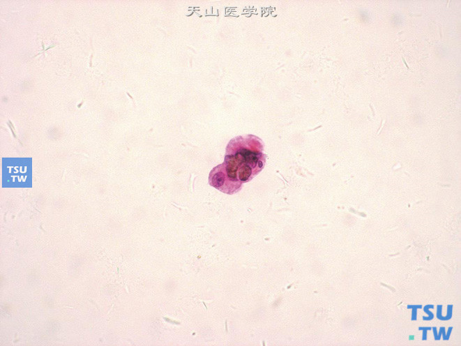 图中央可见结石碎屑，外周围绕着增生的上皮细胞，其核质比增高，但核染色质匀细，核膜规整，可见小核仁（肾结石）
