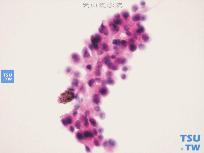 簇状排列的腺样细胞团，细胞核偏位，可见小核仁，胞质空泡状、左下边缘的细胞内可见褐色色素（前列腺按摩后的自然尿标本）