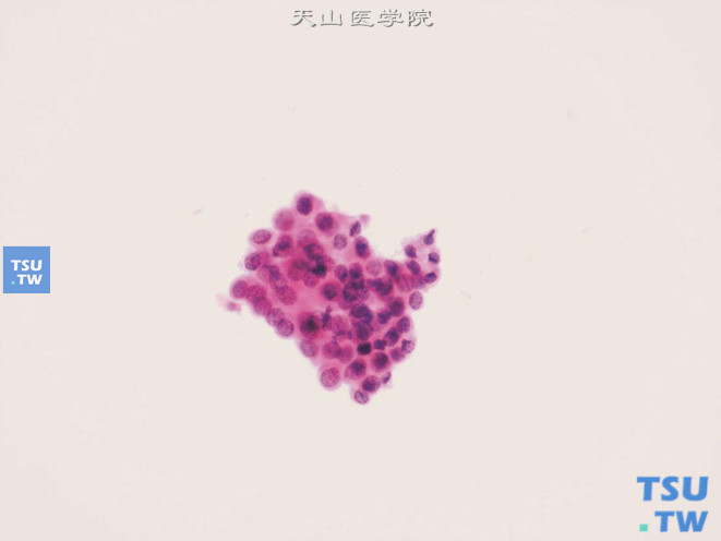 成片排列的上皮细胞团，细胞核膜圆整，核染色质细颗粒状，偶见小核仁，胞质红染颗粒状（前列腺按摩后的自然尿标本）