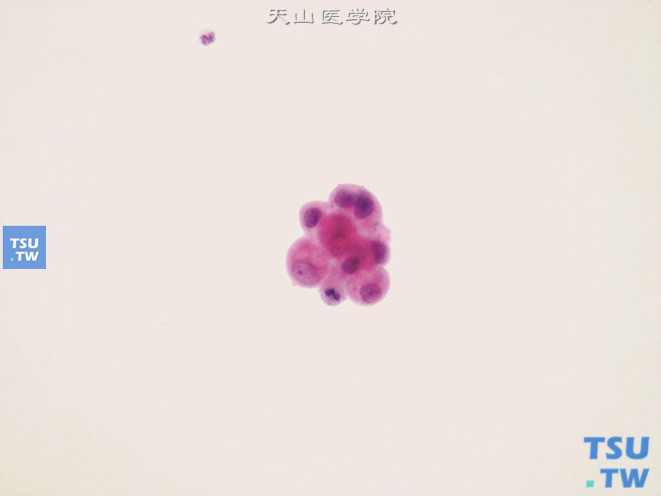 膀胱肾源性腺瘤：图中央可见小团腺上皮细胞，细胞轻度异型，具有清晰小红核仁