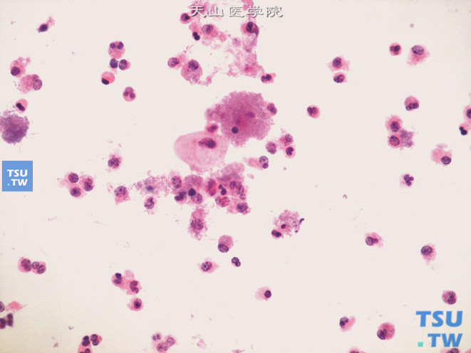 大量炎症细胞的背景下，可见散在的尿路上皮细胞，有的细胞表面覆盖大量细菌，形态类似宫颈涂片中的线索细胞