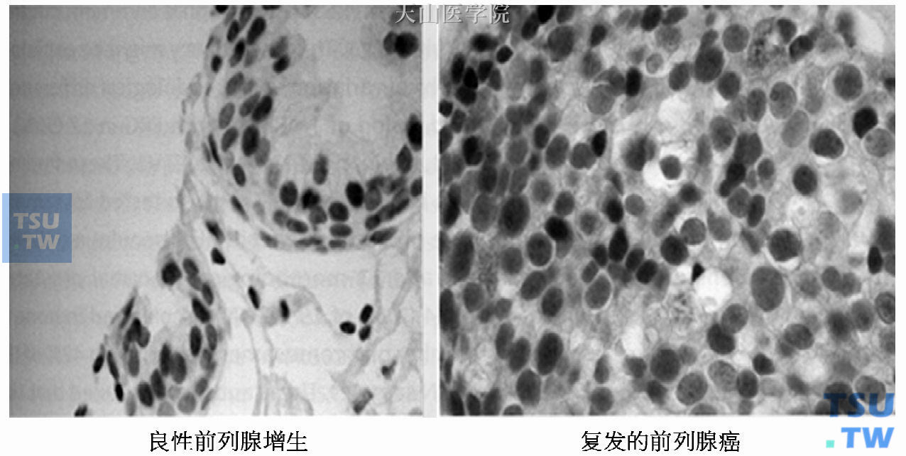 雄激素受体在良性前列腺增生症和复发的前列腺癌中表达