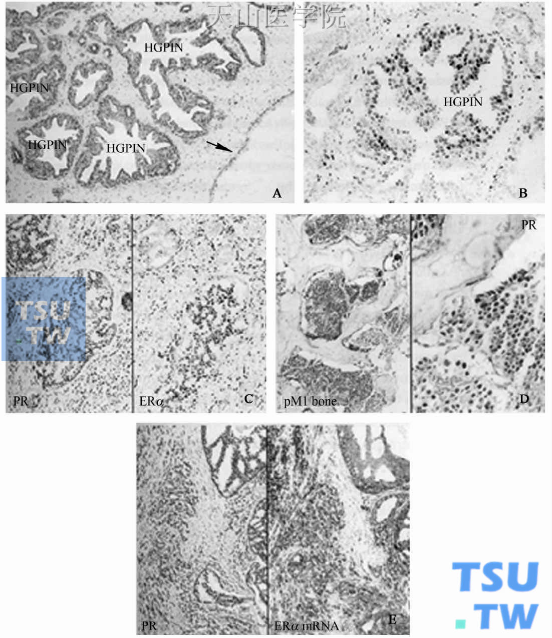 雌激素受体α（ERα）、孕酮受体（PR）在HGPIN（A，B）和前列腺癌（PCa）（C，D）中不同的表达