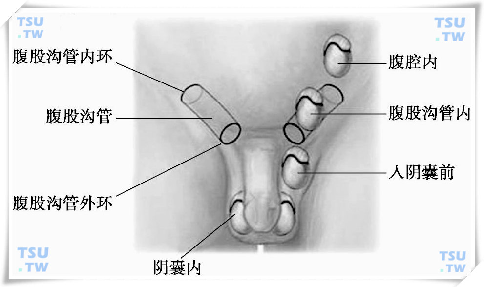 睾丸的下降过程示意图