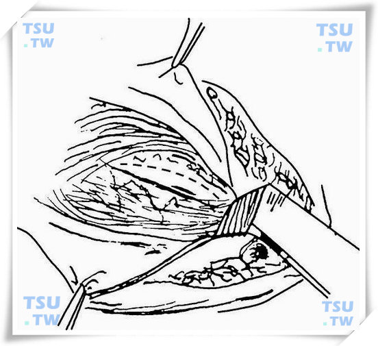  图1 切开腹外斜肌腱膜