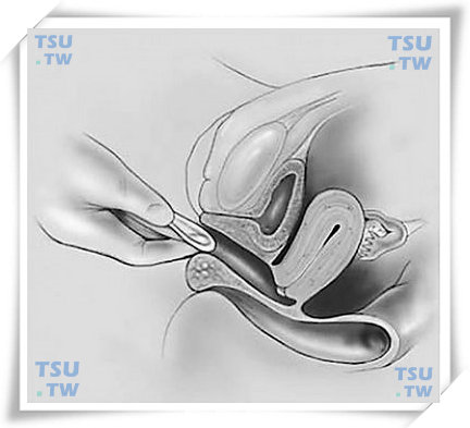  图1　折叠和置入已经润滑的阴道隔膜