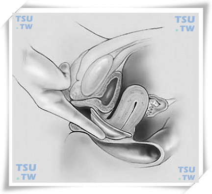  图2　通过阴道隔膜顶部触摸宫颈