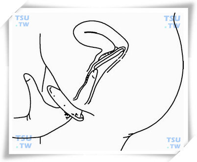  图2　女用避孕套的放入位置