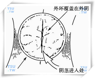 子宫帽 放置图片