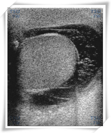 睾丸鞘膜积液超声像图