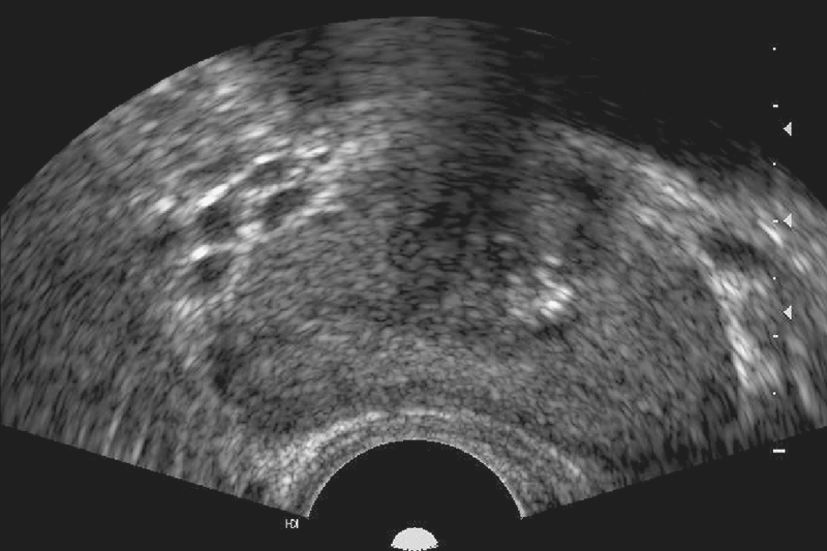 前列腺超声波检查- 男科学- 天山医学院