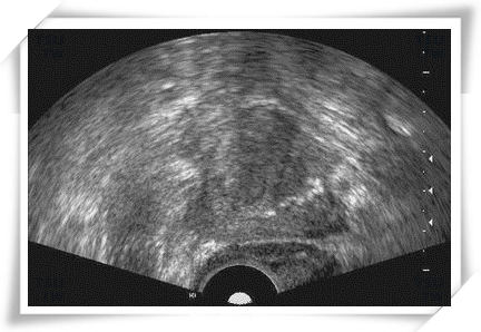  前列腺癌不均匀团块
