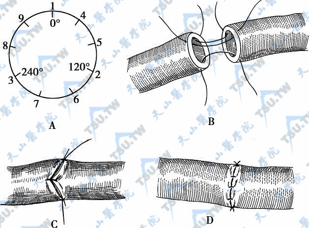 血管端侧吻合术图解图片