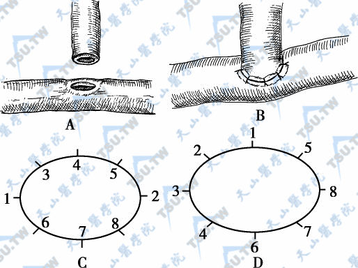 血管端侧缝合