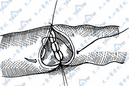 血管端侧吻合术图解图片