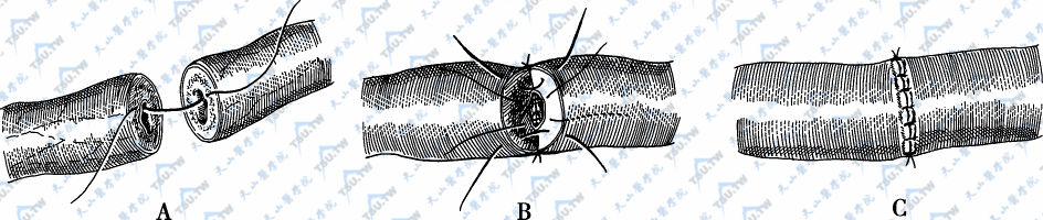 输精管两层缝合术