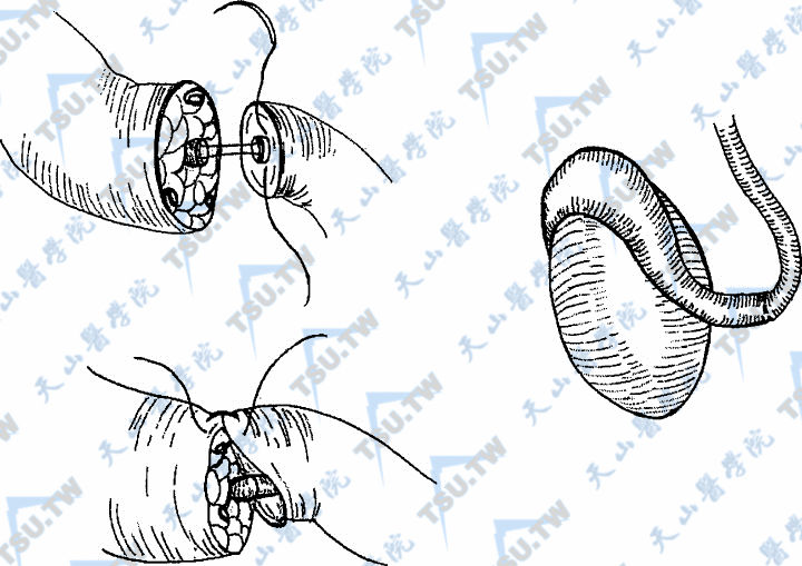 输精管附睾端端吻合法
