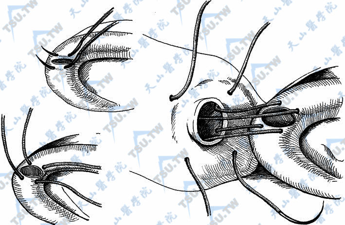 输精管附睾端侧吻合术（横形两针套入法1）
