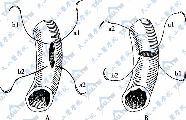 输精管附睾端侧吻合术（纵形两针套入法2）