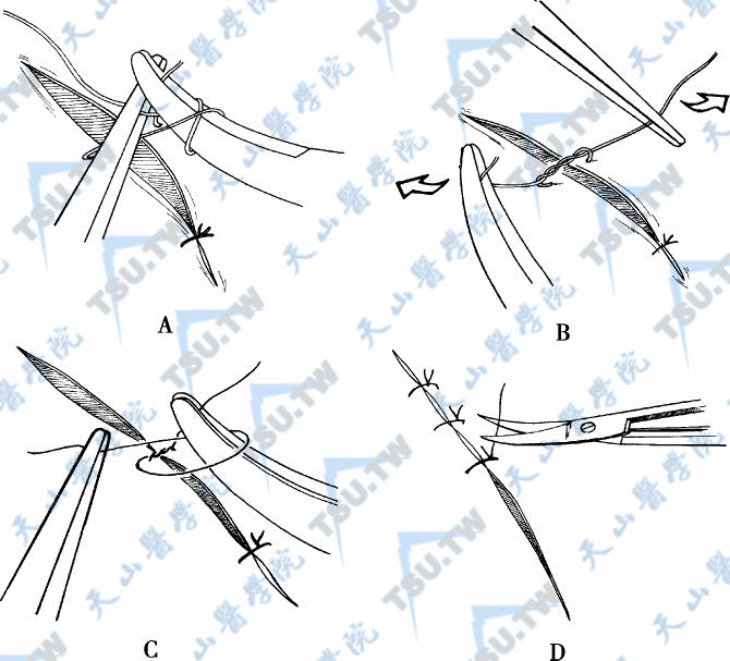 当双环完成后，用持针器尖端夹住缝线短端（A）。把镊子和持针器平稳地水平拉开就完成了第一个双环结（B）。完成第二个单环结，完成第二个和第三个结后外科结就完成了（C）。用显微外科剪剪断缝线（D）