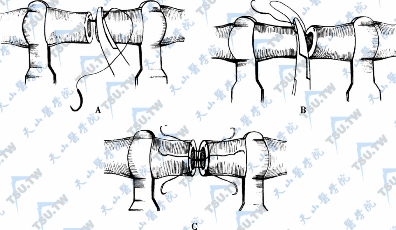 用双层法练习端端输精管吻合术。正手法（A）和反手法（B）都可以用来把双针缝线（10-0）从里到外穿进内黏膜层（C）