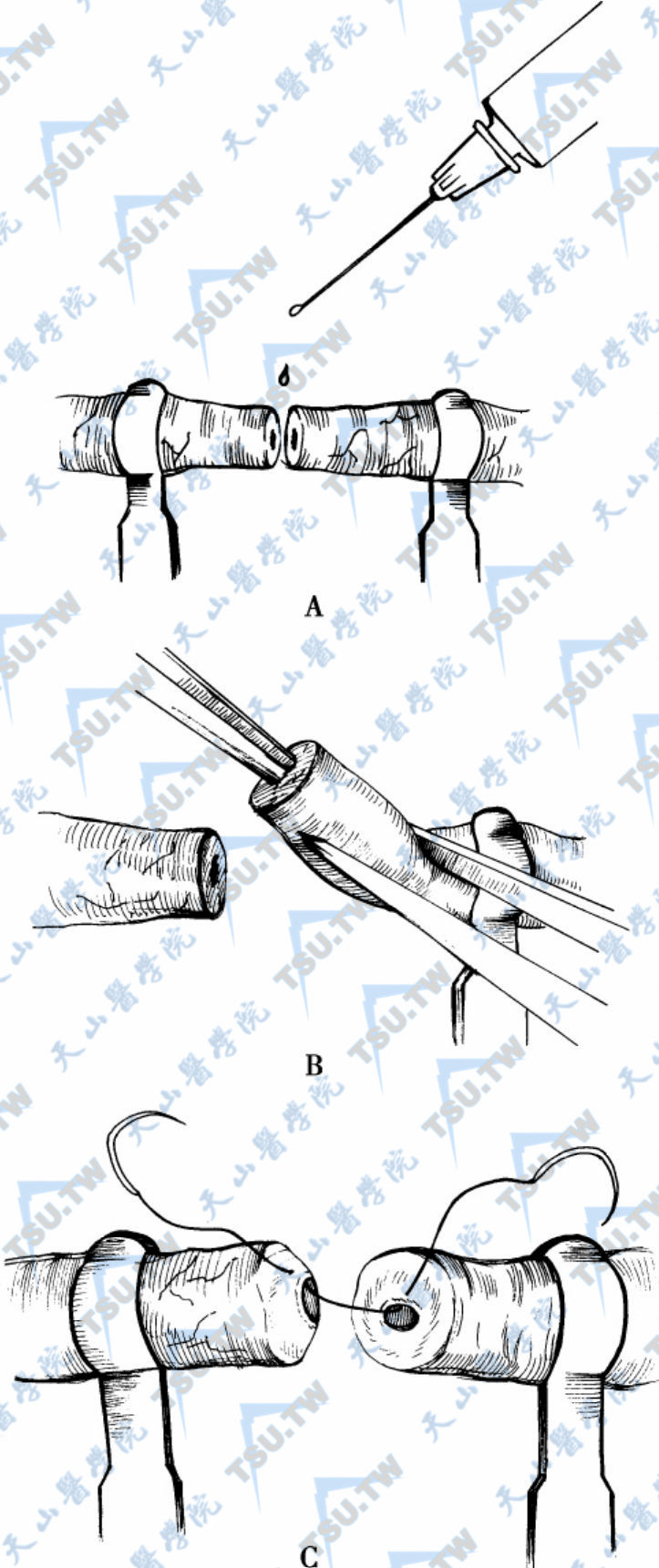 在输精管吻合练习过程中，输精管节段要时刻用生理盐水保持湿润（A）。如果输精管腔不是清晰可见，用圆头精细显微血管扩张器轻轻扩张内腔（B）。扩张后可以看到黏膜环，两个输精管末端都要仔细检查，如果用的是双针缝线的话，针从里向外穿过黏膜层（C）