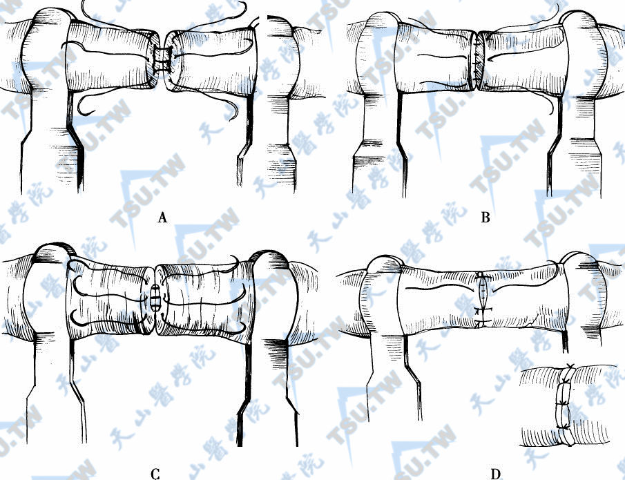 把三条粘膜10-0双针缝线从里到外穿过粘膜（A）。当粘膜缝线打过外科结，在每对粘膜缝线之间分别把几根9-0单针缝线穿过肌肉层及外膜层（B）。当前层缝合完成后，把吻合器翻过来在相反方向折叠使对侧粘膜暴露以进行后层粘膜和肌层吻合（C）。用几段缝线完成肌层和外膜层的吻合（D）